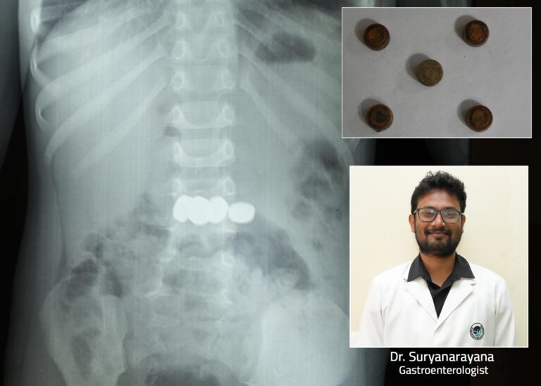 രണ്ട് വയസ്സുകാരൻ വിഴുങ്ങിയ അഞ്ച് ബാറ്ററികൾ എൻഡോസ്കോപ്പിയിലൂടെ സുരക്ഷിതമായി പുറത്തെടുത്തു